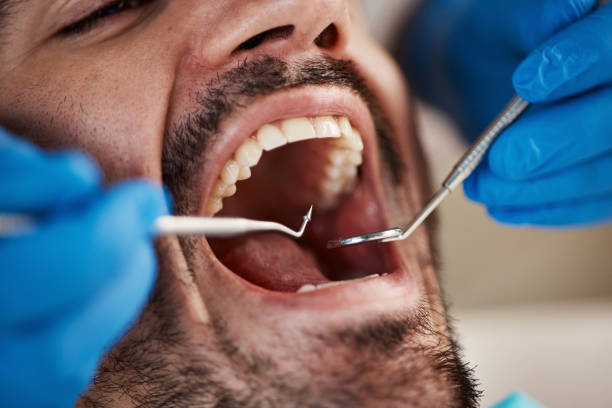Best Broken or Chipped Tooth Repair in Butler, OH