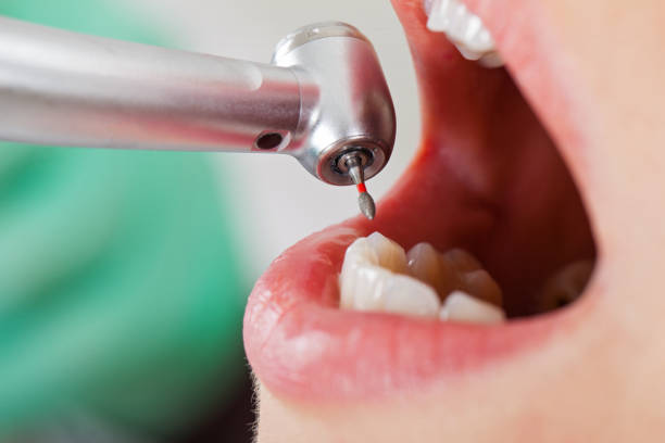 Best Emergency Root Canal Therapy in Butler, OH